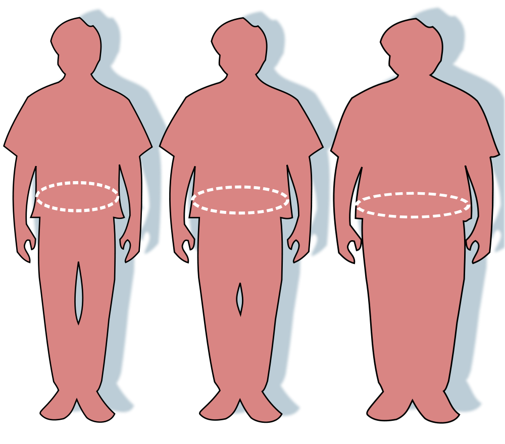 Waist Circumference Obesity