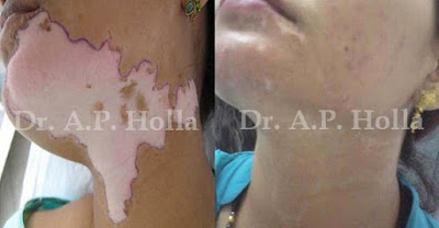 http://www.vitiligo-surgery.com/