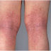 एक्जीमा, Eczema and Your Skin | Eczema Types, Symptoms, Causes