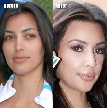  Kardashian Implants on Kim Kardashian Before After Lip Injections   Cosmetic Plastic Surgery