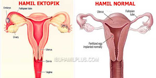 HAMIL DILUAR KANDUNGAN (KEHAMILAN EKTOPIK TERGANGGU)