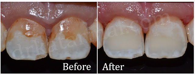 Teeth Whitening for Dental Fluorosis