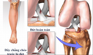 Đứt Dây Chằng Đầu Gối Có Đi Lại Được Không