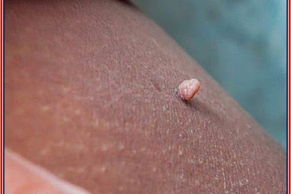 This Is the Only Way You Should Remove Skin Tags According to a Dermatologist