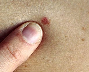 skin cancer photos early stages