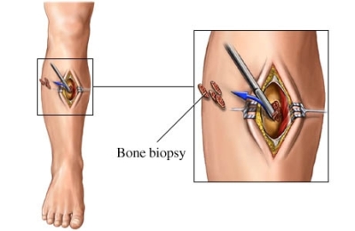 Sarcoma Biopsy