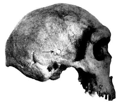 Ancient Bullet in a Rhodesian Man's Skull: Out-of-place Artifacts (OOPArt)