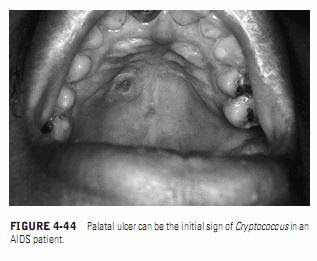 ORAL MANIFESTATIONS