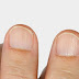 Do You Have Vertical Ridges On Your Nails? (Cause)