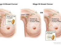 Pengobatan Manjur Kanker Payudara Stadium 2