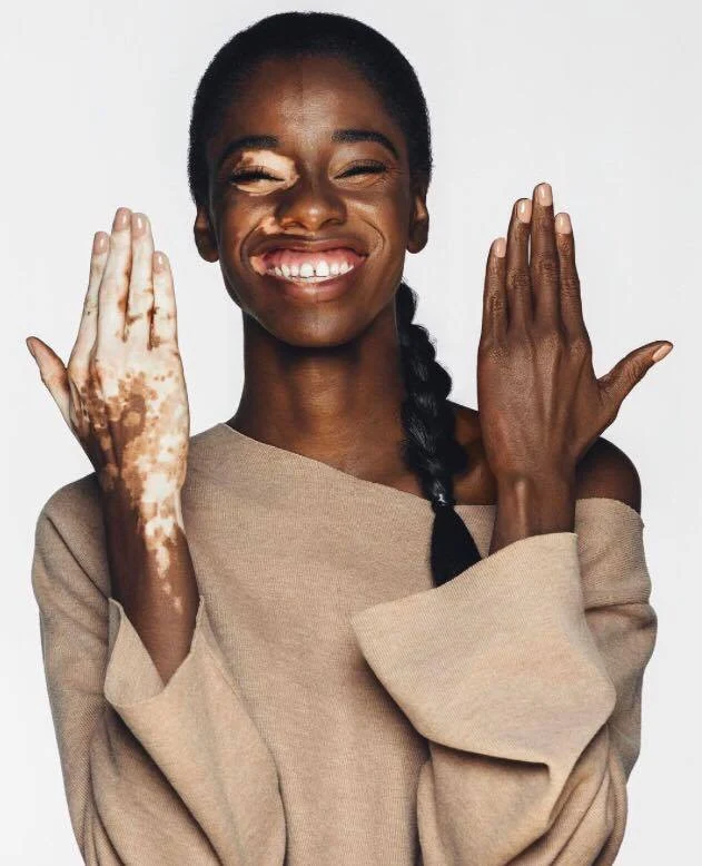 El Vitiligo de Aiesha Robinson - Born To Rise.