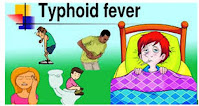 typhoid