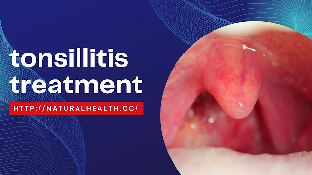 tonsillitis treatment