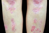 So What Actually Is Psoriasis?