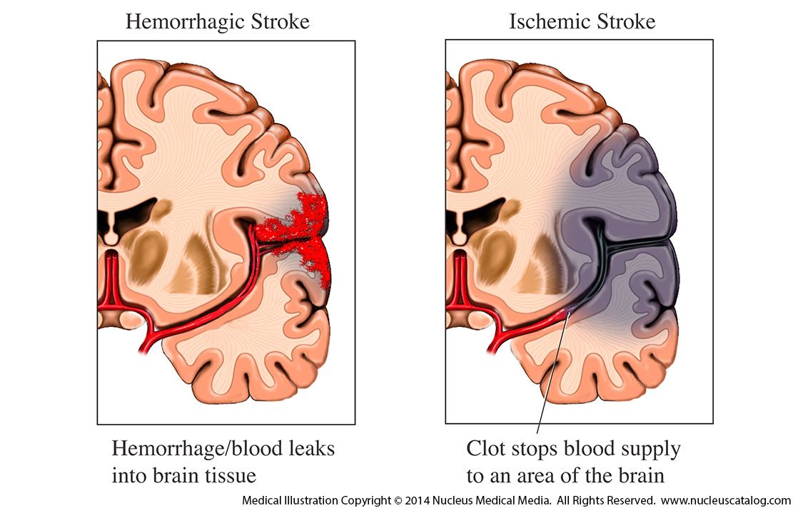 Obat stroke, obat herbal stroke, obat menyembuhkan stroke, obat menangani stroke, obat untuk stroke, obat alami stroke 