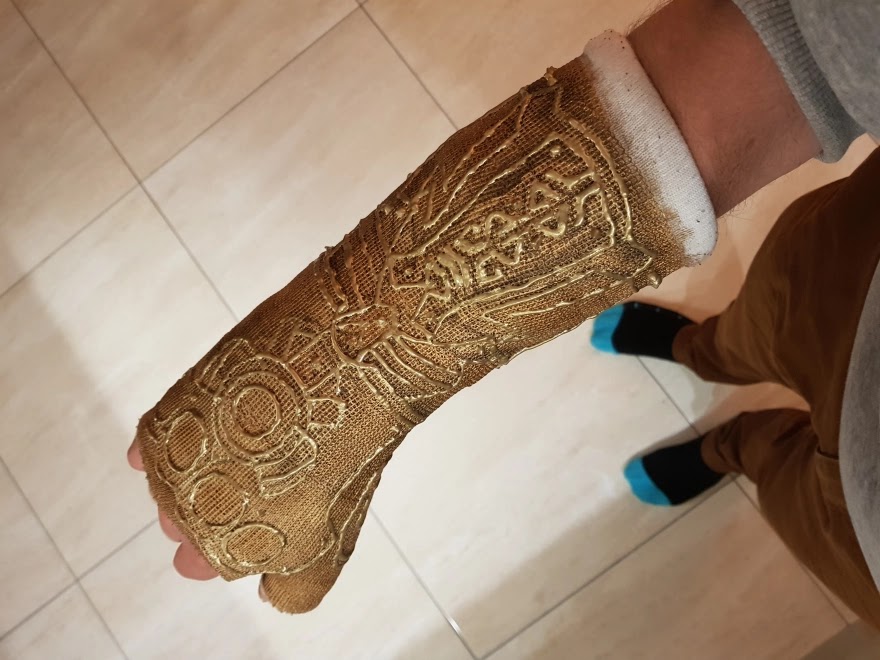 After This Guy Broke His Wrist, He Decided To Transform His Cast Into The Infinity Gauntlet Of Thanos