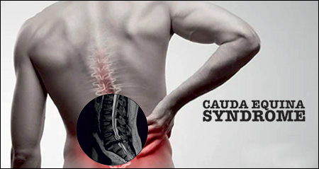 Cauda Equina Syndrome