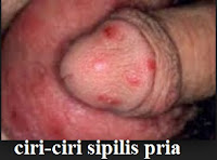 TENTANG OBAT SIPILIS HERBAL 