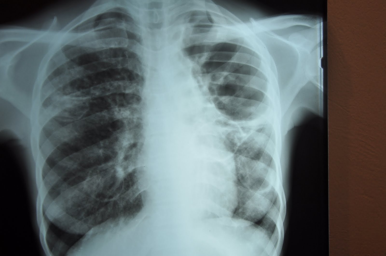 Chest x-ray: Pulmonary