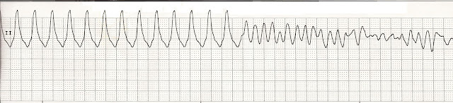 Float Nurse: EKG Rhythm Strip Quiz 5