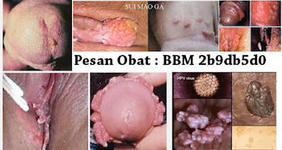 Penjual Obat Kutil Kelamin Di Bojonegoro