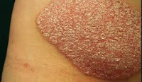 obat tradisional untuk penyakit kulit psoriasis atau kulit bersisik