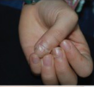 Monkeypox Pictures, Mokeypox Photos blackened fingernail