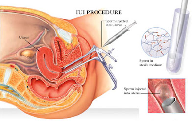 http://kasturihospitals.com/gynaecology/iui/