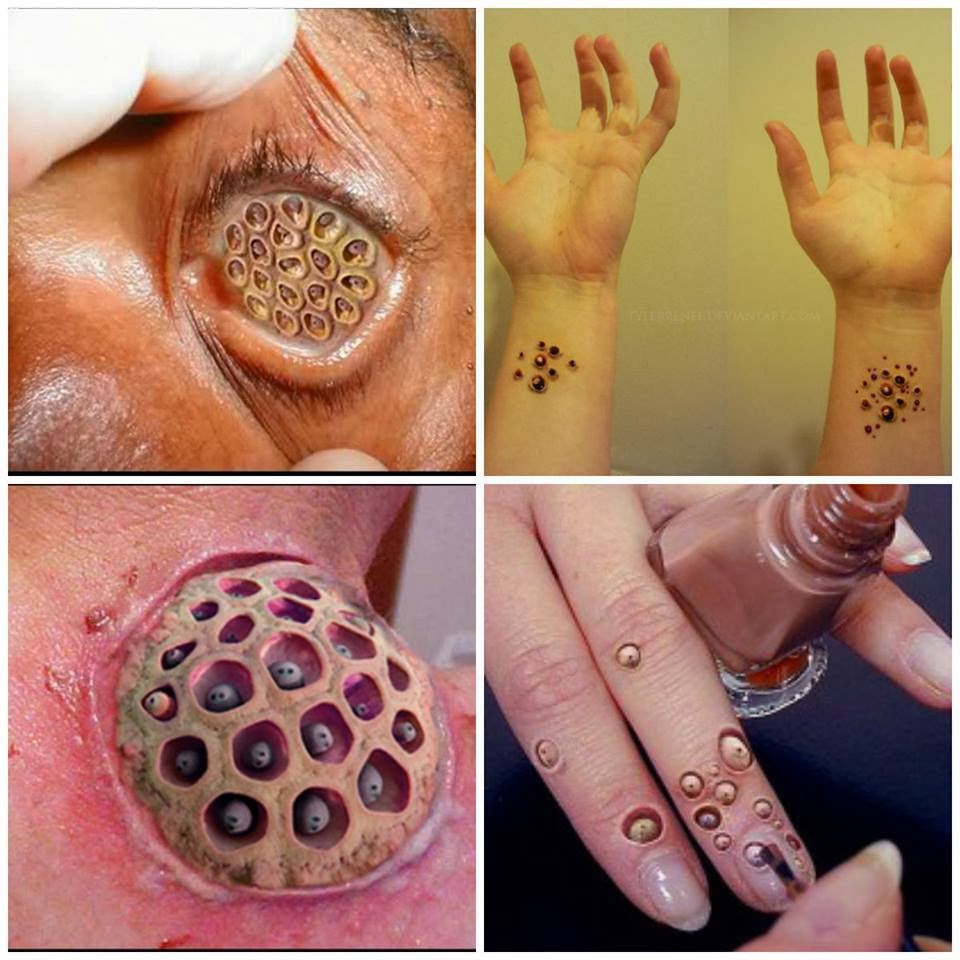 Penyakit Trypophobia sejenis penyakit pada kulit yang amat menggelikan 