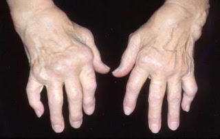 milagros untuk rheumatoid arthritis 