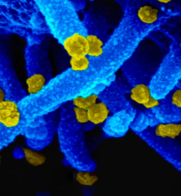 WHO Worry About MU Variant (B.1.621) Immune To Vaccines The World Health Organization (WHO) is wary of the mutation of the Corona virus (Covid-19) variant Mu or B.1.621 which is feared to be vaccine-resistant. On the other hand, currently the Delta variant or B.1.617.2 is reported to dominate the world's infection cases.  Mu is the fifth variant of Covid-19 monitored by WHO since last March. Although more research is needed, the WHO warns this variant has a number of mutations that suggest it could be more resistant to vaccines.  "The Mu variant has a constellation of mutations that exhibit potential immune evasion properties," the WHO said in a statement some time ago as quoted in The Washington Post newspaper report.  Preliminary data suggest there is a decrease in vaccine effectiveness, similar to that seen for the Beta variant. WHO said it would monitor the spread of the Mu variant in South America, along with the Delta variant. 21 Point Mutations In Variant Mu The MU variant carried at least 21 point mutations in the genetic material of SARS-CoV-1, nine of which were in the viral spike protein. The key mutations of the Mu variant include N501Y such as the Alpha variant, E484K such as the Beta variant, and P681H such as the Delta variant.  To date, the spread of the Mu variant among Covid-19 cases in the world is below 0.1 percent. An expert in infectious diseases and genomics at the University of San Francisco de Quito in Ecuador, Prof. Paúl Cárdenas said the public need not worry about the development of the Mu variant. The Mu variant has a relatively low risk of spreading.  Until now, WHO also noted that the rate of spread has not increased soaring. The Mu variant was first detected in Colombia early last year and has now spread to 40 countries. This variant has spread to the United States, parts of Europe and South America, and Japan. The Difference Between Delta and Mu . Covid-19 Unlike the Covid-19 MU variant, the Delta variant of Covid-19 has the ability to infect easily and quickly. The variant was first detected in India and spread to more than 60 countries, including Indonesia.  Bhakti Hansoti, professor of emergency medicine and international health at Johns Hopkins University, said Delta variant infections in India and the US showed the same symptoms as the early Sars-CoV-2 virus. However, the symptoms that appear due to infection with the Delta variant tend to be more severe.  Hansoti said doctors found an increased likelihood of hearing loss, severe stomach pain and nausea in patients infected with the Covid-19 Delta variant. In most cases, patients with Delta variant infection usually require hospitalization and require more treatment and oxygen supply, in addition to experiencing complications.