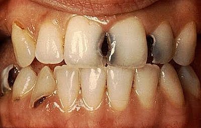 Image result for gambarkaries gigi