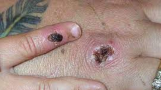 Monkeypox is a contagious virus that spreads through the body. Monkeypox Diseases