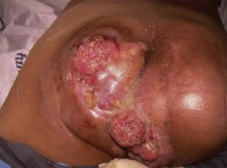 Fistula disease can recur,fistula for definition,fistula surgery