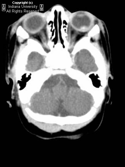 Toxocariasis (no calcification