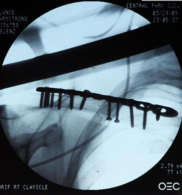 lance armstrong x ray image Foto Hasil Sinar X yang Mengerikan