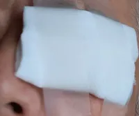 ガーゼをあてただけ