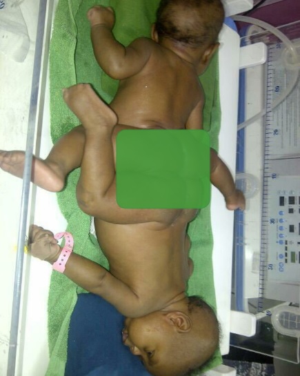 Photos: Nigerian Conjoined Twins Miracle & Testimony Ayeni’s Surgery Sponsored By Arik Air