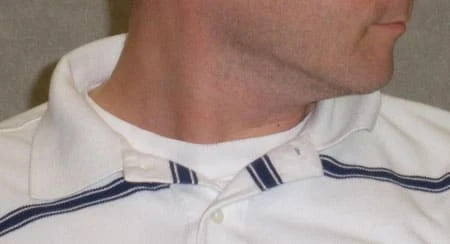 Patient with severe left torticollis (note hypertrophy of right sternocleidomastoid muscle)