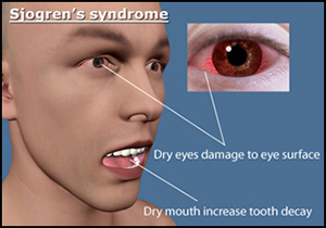 Sjögren's syndrome, herbal treatment, causes, symptoms, dry eyes, dry mouth