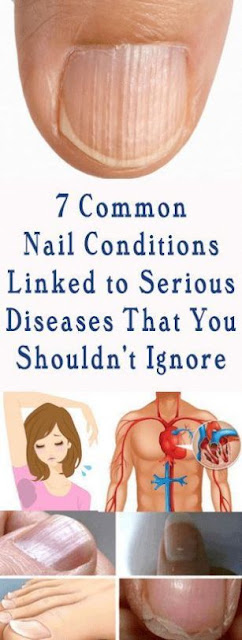 These 7 Conditions Of Nails Linked To Serious Diseases That you Shouldn’t Ignore