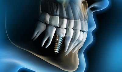 Trồng răng implant mất bao lâu thì hoàn tất? 1