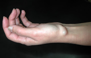 imagen que muestra en una muñeca el ganglión, que es una elevación de la piel en forma de una nuez
