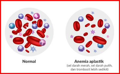 mengenal penyakit anemia aplastik