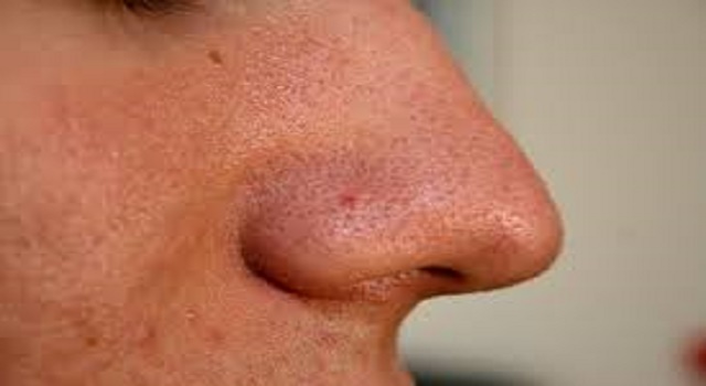 blackheads Philippines