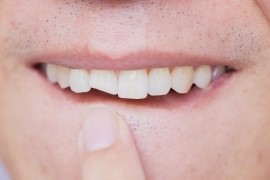 Suffering From a Badly Cracked Tooth: Things To Consider When Deciding What To Do
