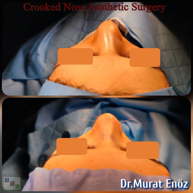 Crooked Nose Job Turkey