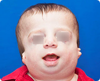 A child with Treacher Collins Syndrome (TCS) treacher collins syndrome pictures