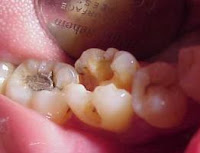 true smile dental clinic Kenapa gigi  yang berlubang  harus 