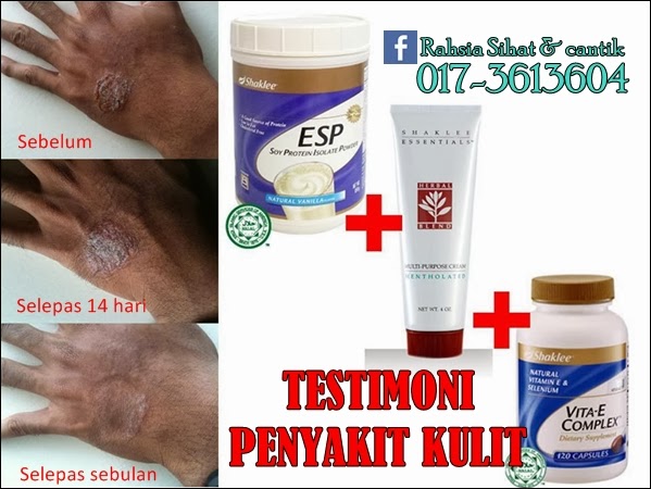 Atasi Penyakit Gatal Kulit, Kurap Dan Eczema Dengan Produk 